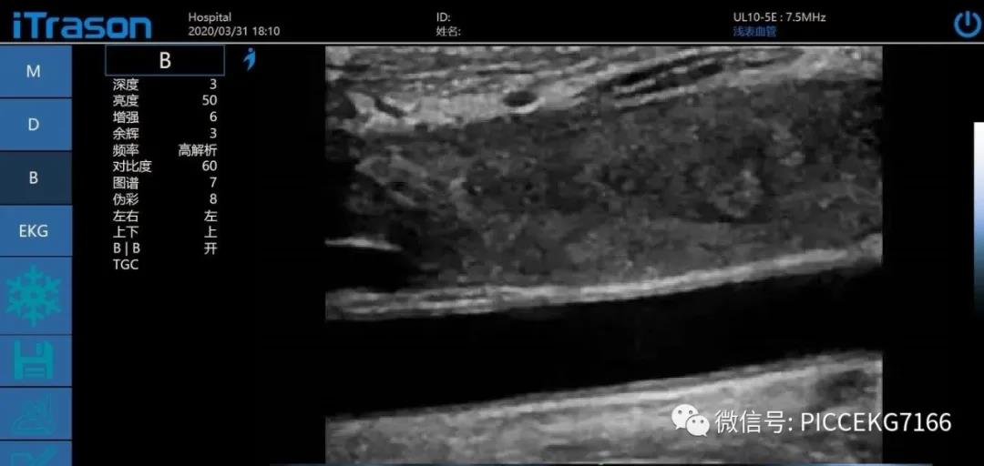 PICC置管中如何区分动静脉？