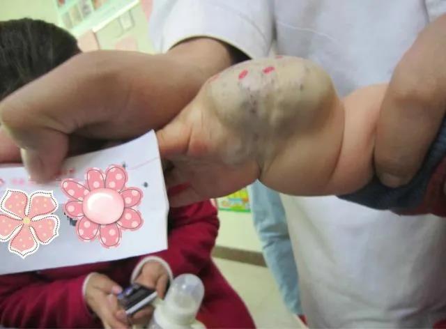 大家知道囊状血管瘤吗，这些血管瘤看上去很可怕，该如何应对呢？