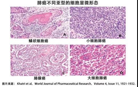 抗癌好药：未经治疗的小细胞肺癌免费用PD-1