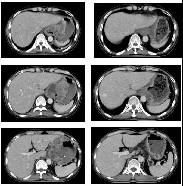 免疫治疗联合化疗 这个晚期患者的肿瘤明显消退！