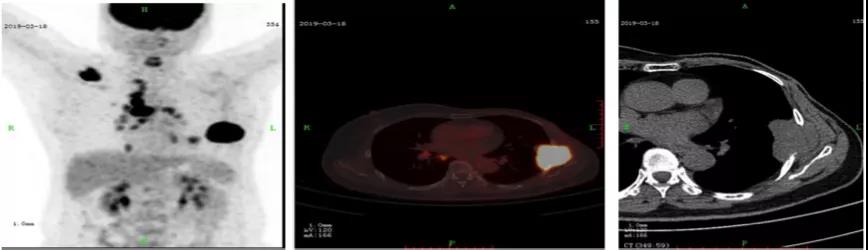 靶向CDK4/6抑制剂一线治疗HR+原发耐药内脏转移乳腺癌患者，假性进展后达到PR，且PFS已超过20个月