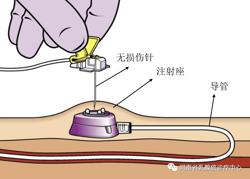 输液港——化疗患者的“守护港”