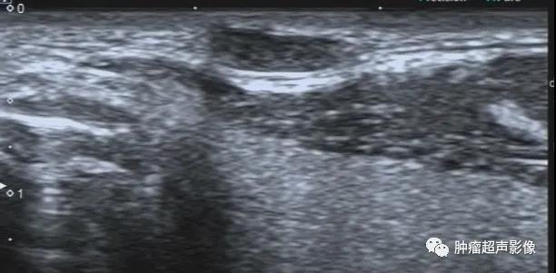 脂囊瘤的超声表现