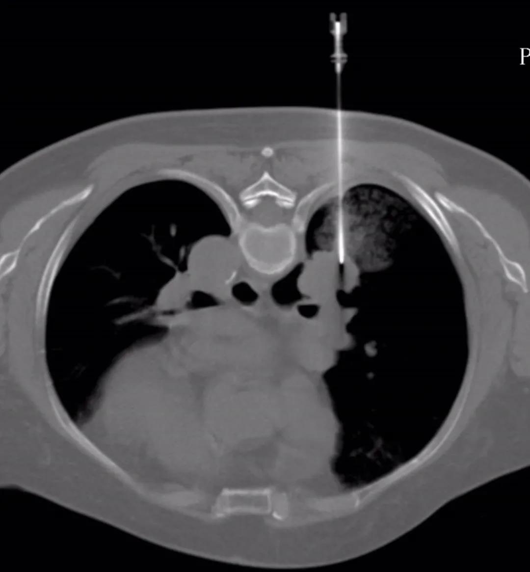 CT导引下经皮穿刺活检，您了解多少？