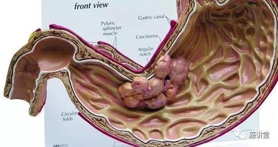 遗传风险，发生胃癌和健康生活方式：全基因组关联研究和前瞻性队列研究的荟萃分析