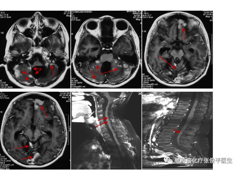 阿帕替尼有效治疗一例复发髓母细胞瘤