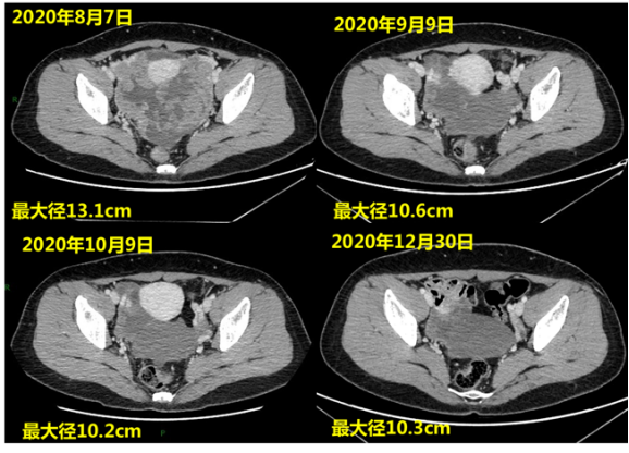 瑞派替尼用于一例耐药后快速进展小肠间质瘤的治疗体会