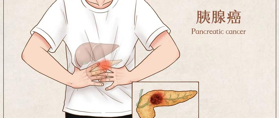 癌中之王的“胰腺癌”可以在多早期的时候发现？