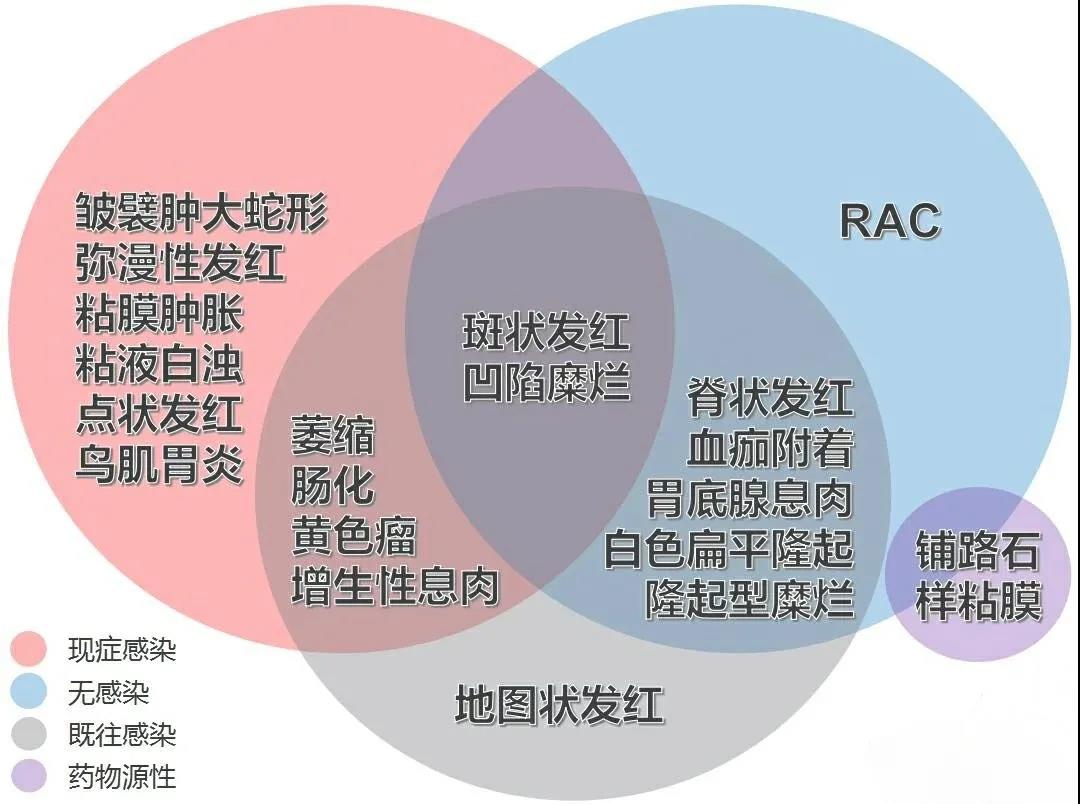 内镜下识别HP与萎缩--京都胃炎再复习