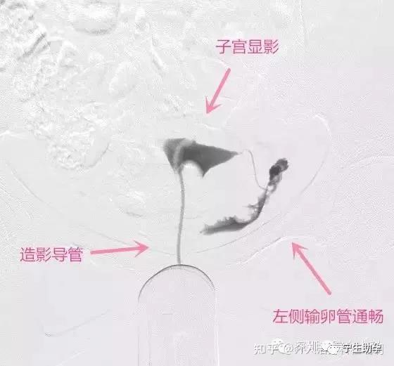 三镜一丝输卵管复通手术