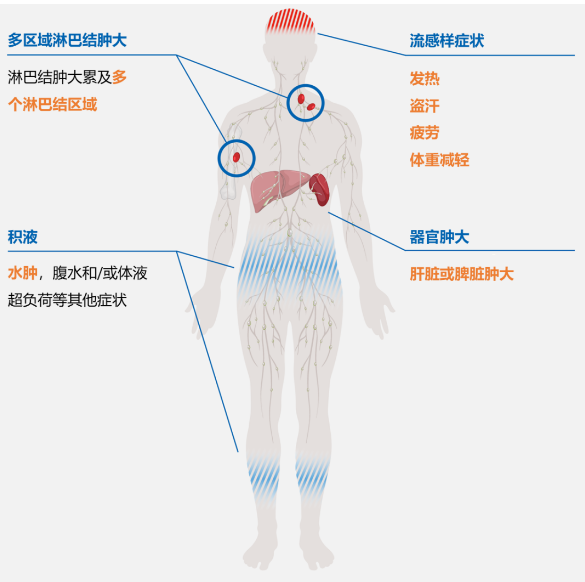 Castleman病诊治进展