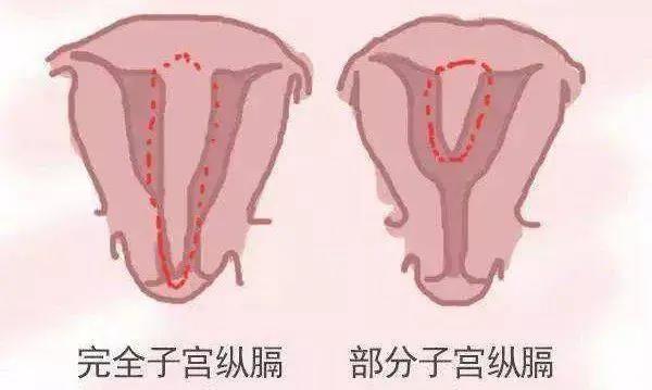拥有双子宫的女人可以怀孕吗？