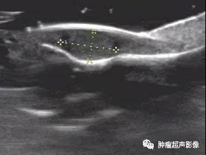 血管球瘤的超声诊断