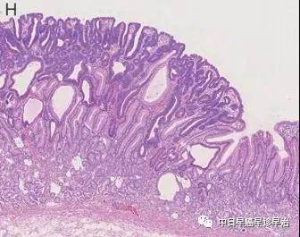 鉴别胃腺瘤和高分化的低异型度腺癌
