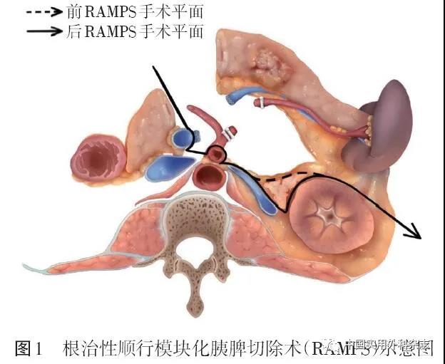 中国胰腺癌诊治指南（2021）