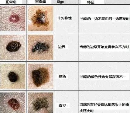 黑色素瘤 黑色素瘤