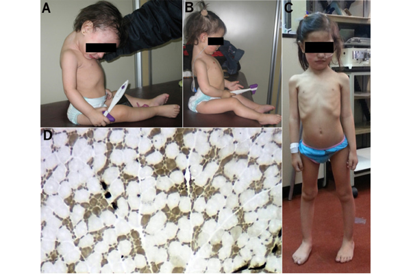 先天性纤维型比例失调