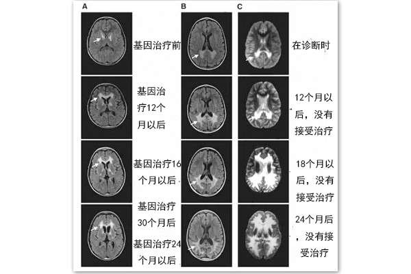 肾上腺脑白质营养不良