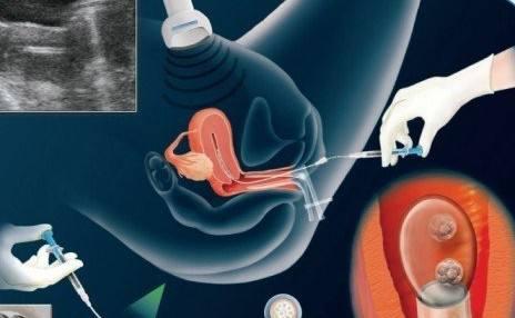 试管婴儿成功率