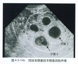 关于减胎 关于减胎