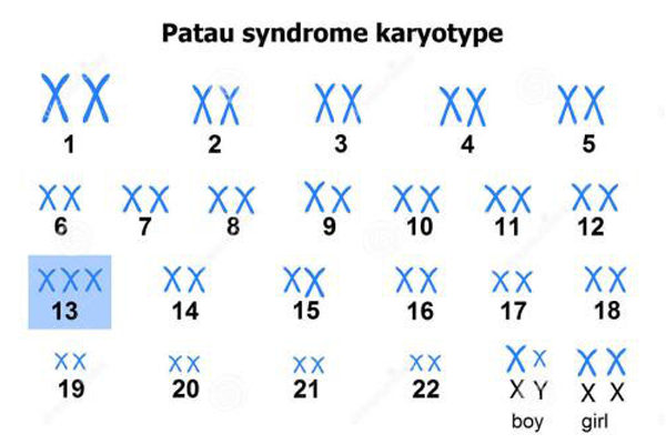 帕陶综合症(13-三体综合症) 帕陶综合症(13-三体综合症)