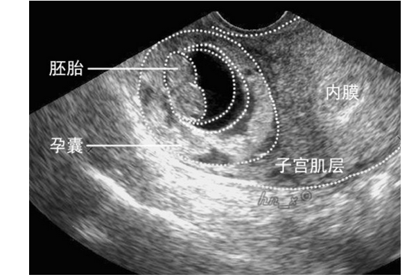 妊娠囊及其在妊娠中的意义