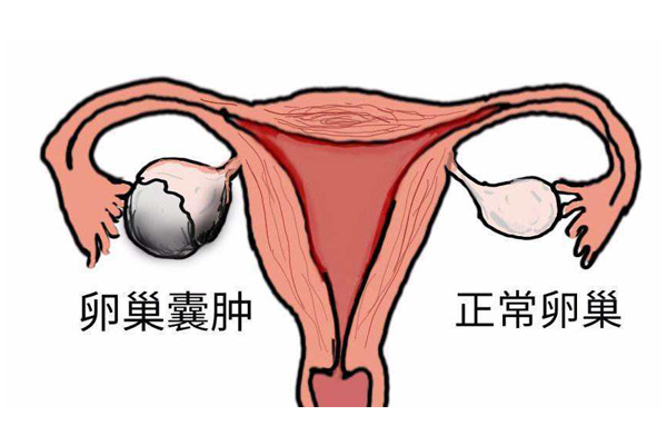 卵巢囊肿对于生育的影响与治疗