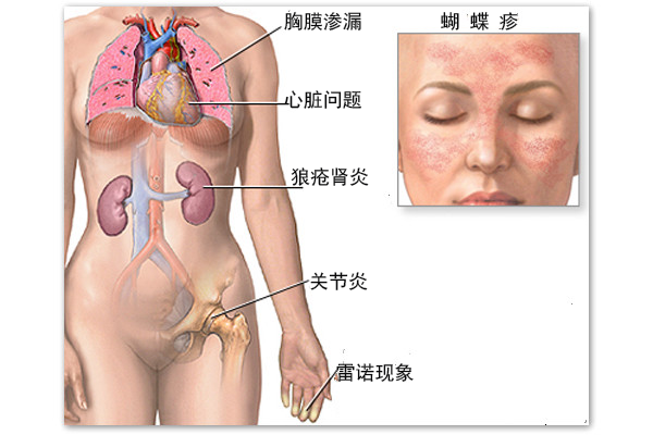 系统性红斑狼疮
