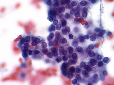 子宫内膜薄，怎么做试管婴儿？