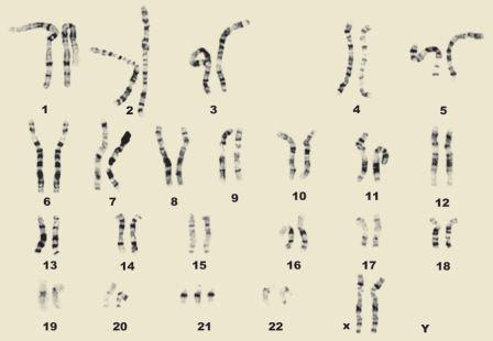 染色体数目异常