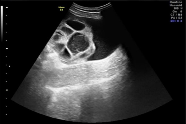 卵巢过度刺激综合征