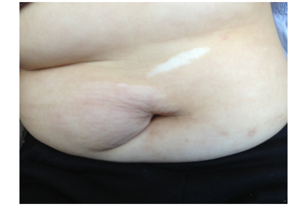 血管平滑肌脂肪瘤 血管平滑肌脂肪瘤