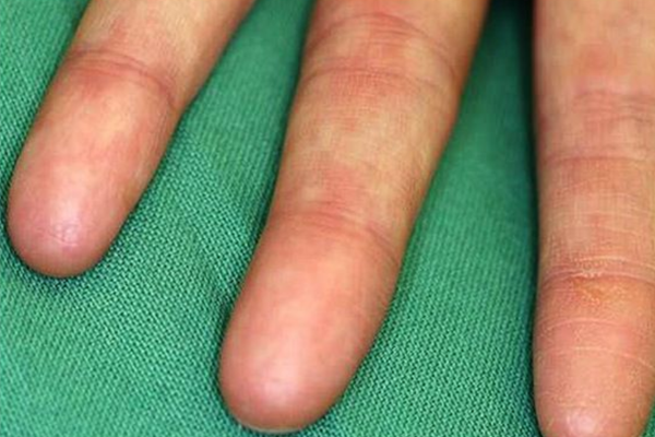 皮纹病会遗传给后代吗