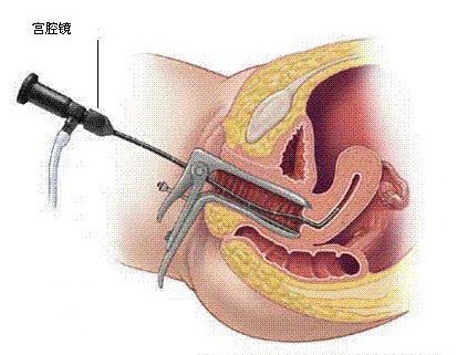 试管婴儿与宫腔镜检查
