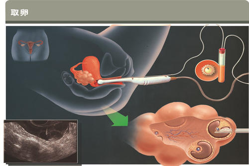 如何准备试管婴儿取卵