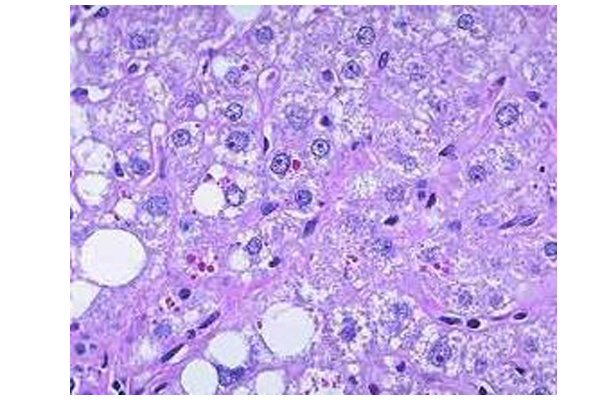 α-1抗胰蛋白酶缺乏症