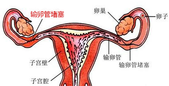 输卵管阻塞的原因、症状和治疗