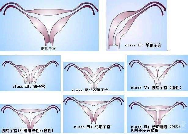 先天性子宫畸形与生育