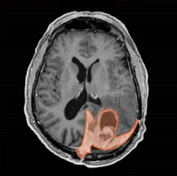 脑膜瘤患者的影像扫描（橙色）