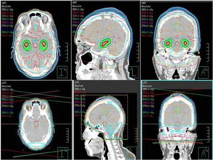 针对脑转移瘤的定制放射可减少认知影响